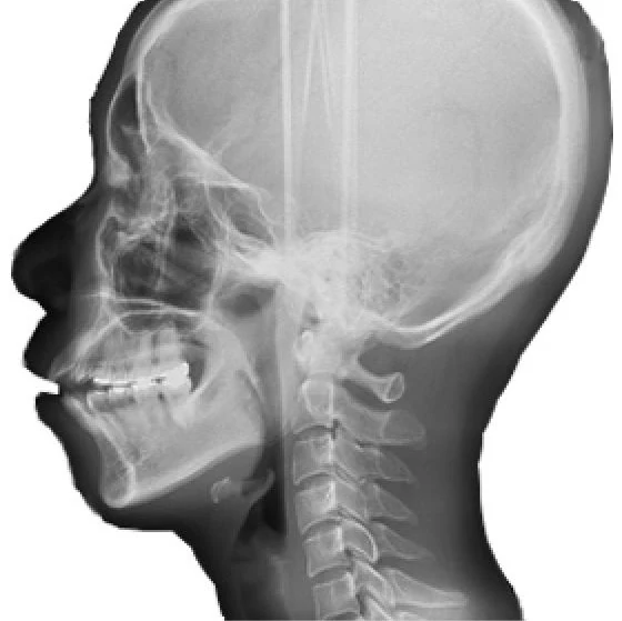 Zdjęcie cefalometryczne wykorzystywane w diagnostyce ortodontycznej – Dentmed Oleśnica