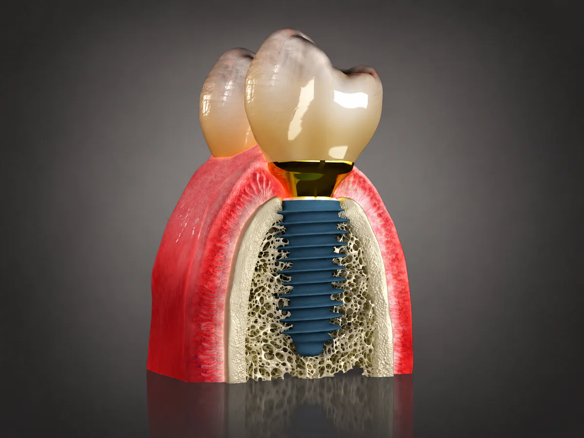 Przekrój implantu stomatologicznego osadzonego w kości